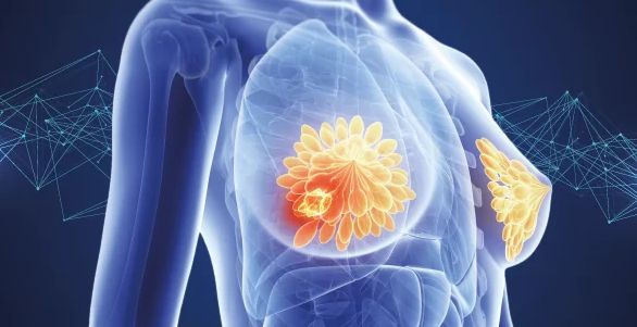 2022 ASCO|乳腺癌最值得期待研究TOP10